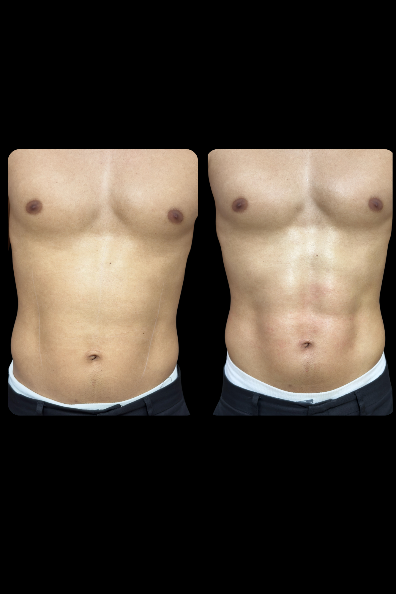 Antes e depois resultado HIPRO